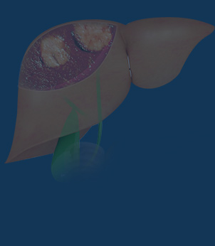 Liver Cancers and other tumours