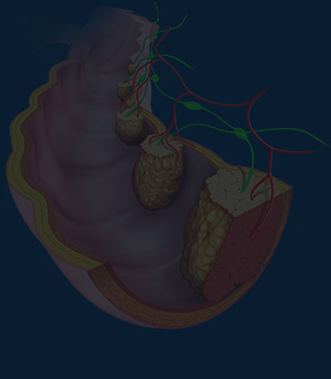 Other Gastrointestinal tumours