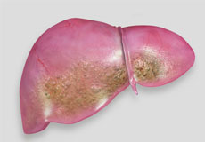 Fatty Liver Disease