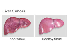 Cirrhosis