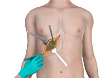 Open Cholecystectomy